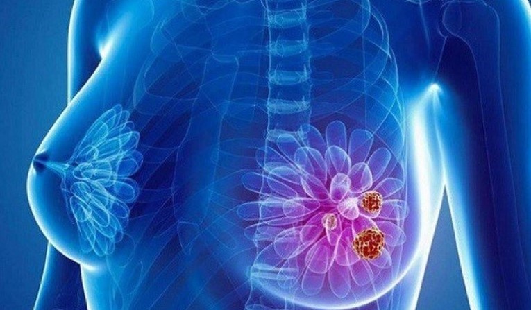 Bạch cầu trung tính có thể khiến ung thư vú phát triển và lan rộng
