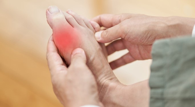 5 nguyên nhân phổ biến gây ra nồng độ axit uric cao 5 nguyên nhân phổ biến gây ra nồng độ axit uric cao