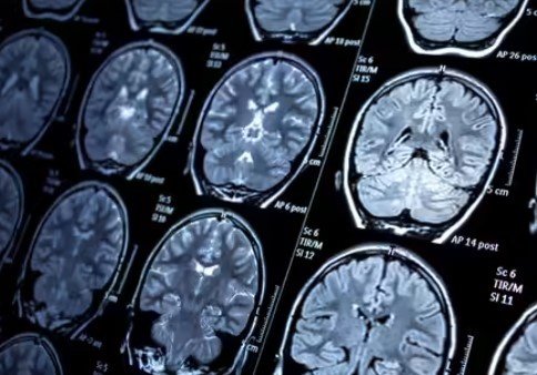 5 triệu chứng ung thư não không chỉ đơn thuần là 